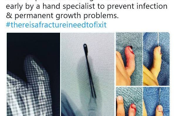 The Seymour fracture