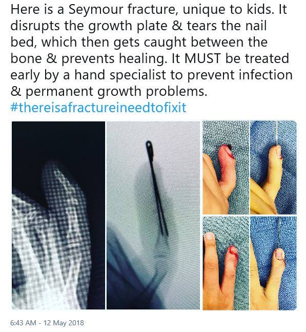 The Seymour fracture – Royal New Zealand College of Urgent Care