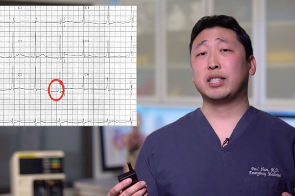 Ordering an ECG for your patient with syncope?