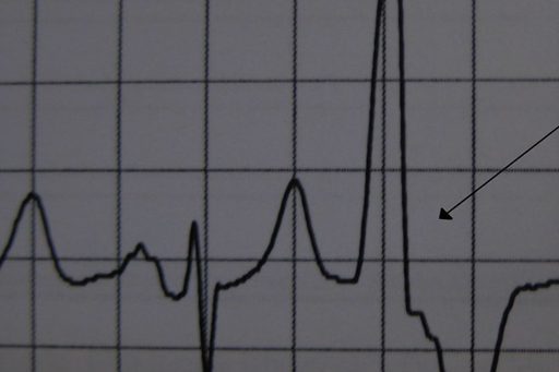Palpitations are a common presentation to the urgent