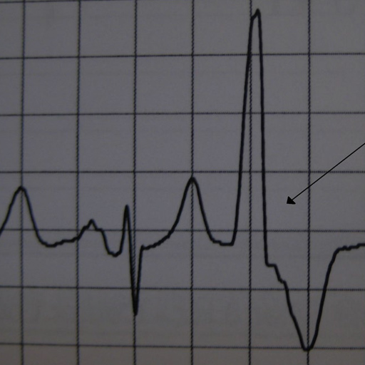 Palpitations are a common presentation to the urgent