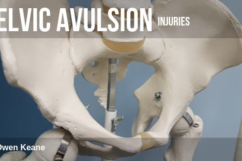 Pelvic avulsion injuries