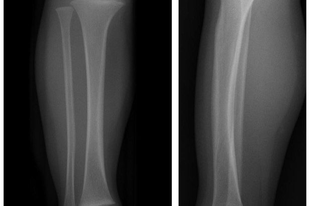 SplintER Series: A Toddler’s Missed Step Resulting in