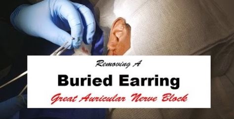 embedded ears removal